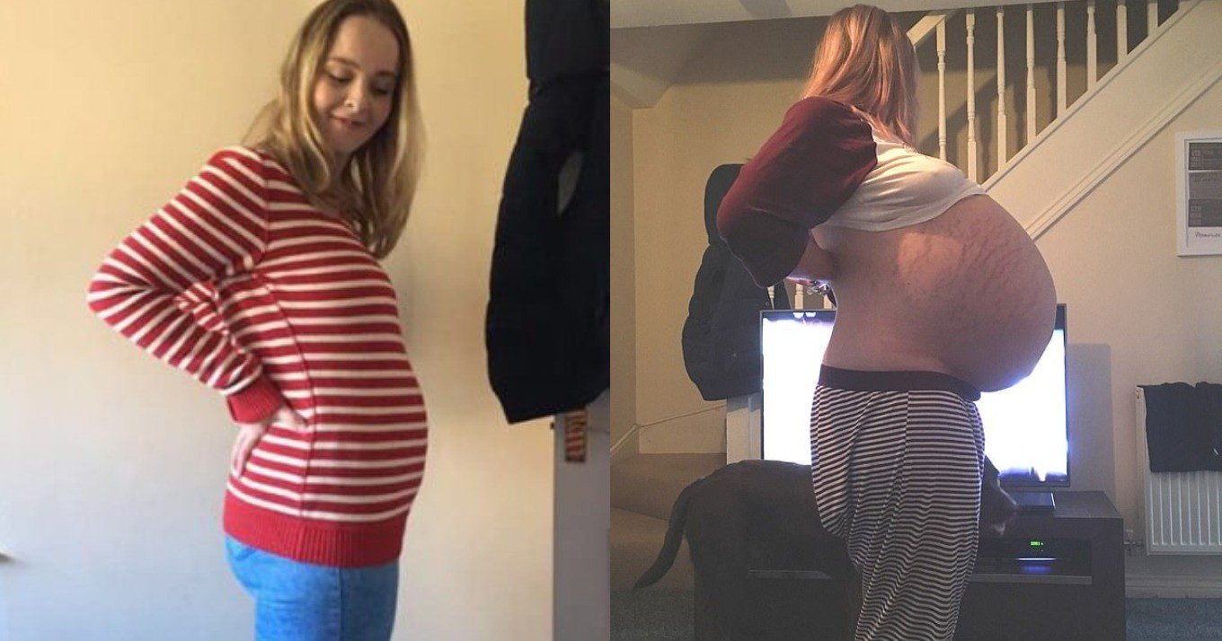 Νόμιζε ότι είναι έγκυος, αλλά μέσα της δεν μεγάλωνε έμβρυο – Έμειναν όλοι άφωνοι μετά την εγχείρηση
