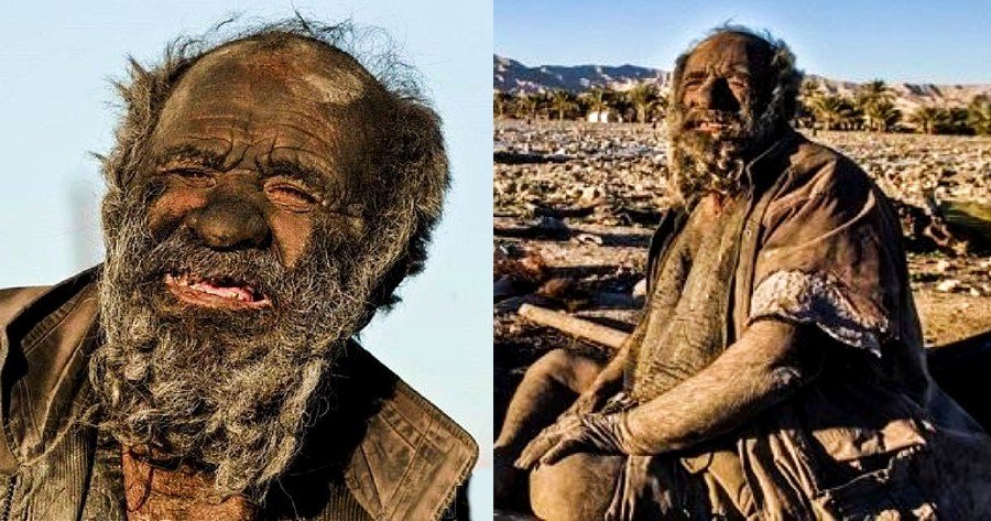 70 χρόνια χωρίς μπάνιο: O πιο βρώμικος άνθρωπος του κόσμου άφησε έκπληκτους τους γιατρούς που τον εξέτασαν