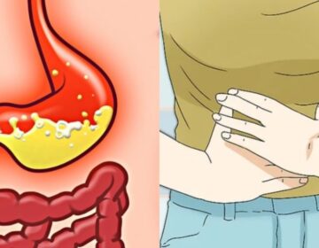 Τι είναι οι καούρες στο στομάχι και τι μπορούμε να κάνουμε